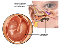 Ear infections