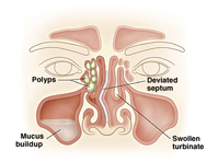 Sinus problems