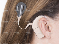 Cochlear implant